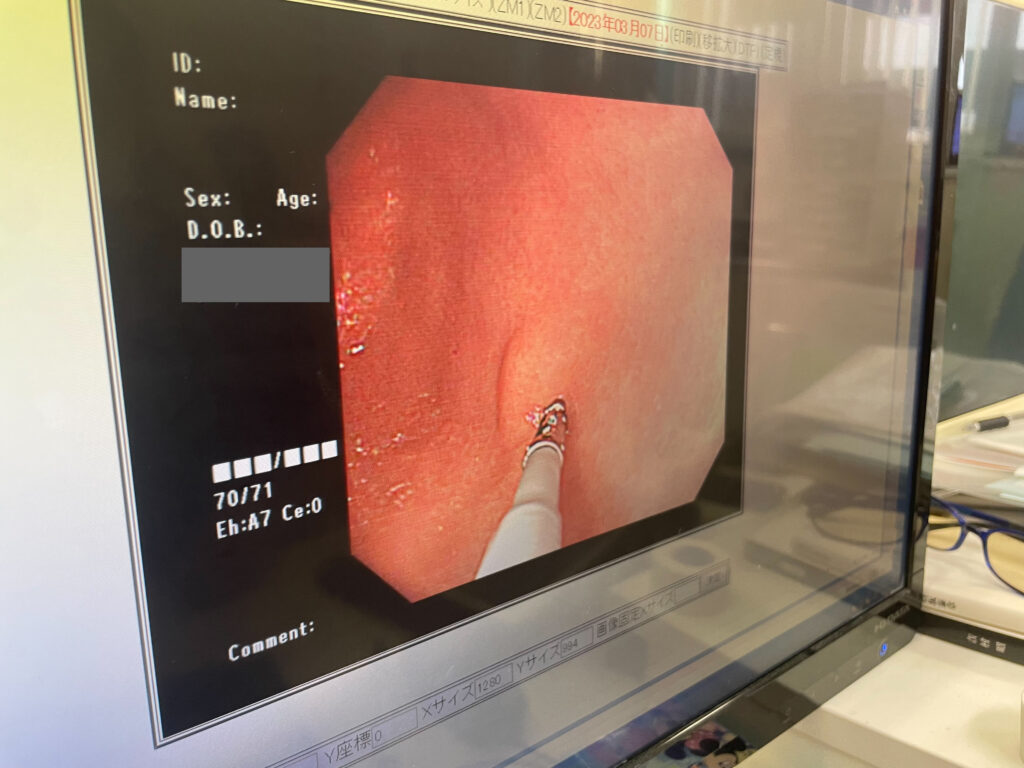 胃カメラによるポリープ写真
フリーランスの胃の写真